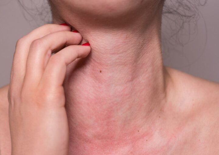 Alergija ir jos simptomai: paraudęs ir išbertas merginos kaklas