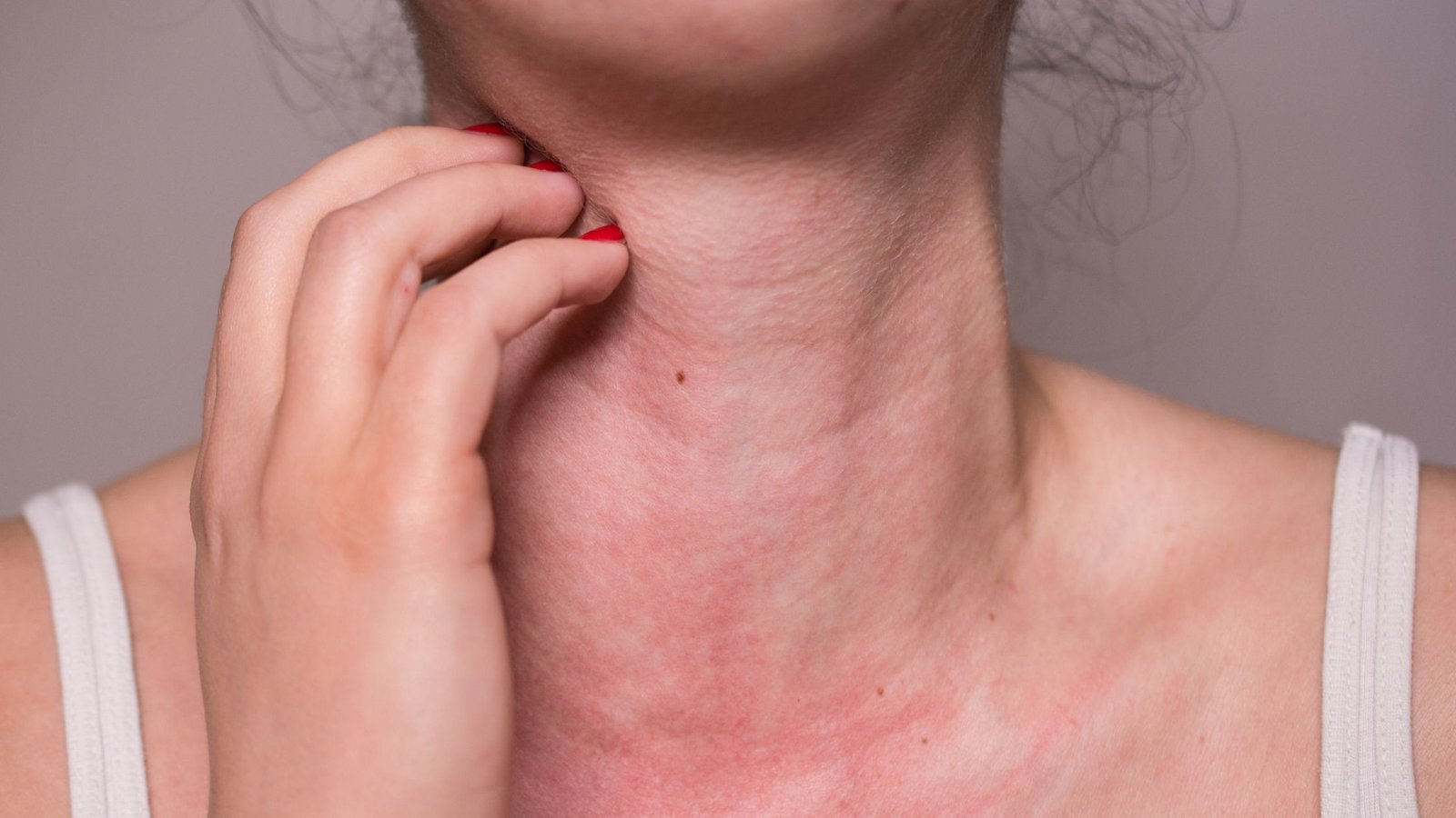 Alergija ir jos simptomai: paraudęs ir išbertas merginos kaklas