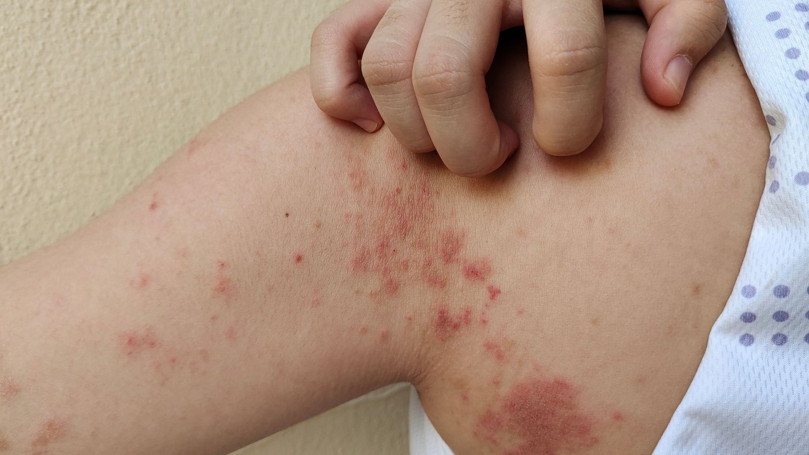 Alergija: priežastys, simptomai ir dažniausi tipai 2 Odos bėrimas, niežėjimas - vienas iš alergijos simptomų